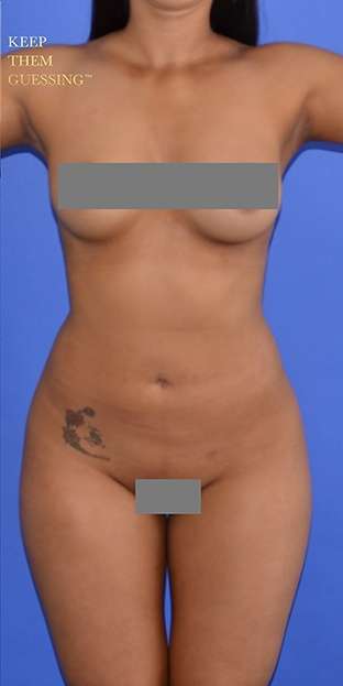 Liposuction before and after - after