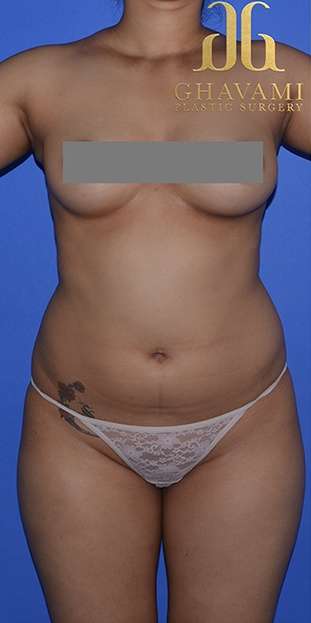 Liposuction before and after - before