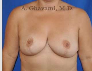 Procedure before and after - after
