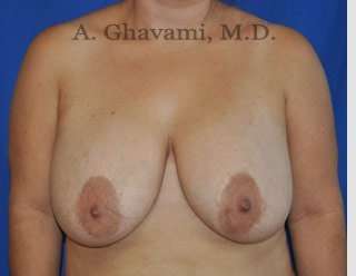 Procedure before and after - before