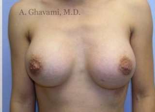 Procedure before and after - after