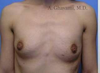Procedure before and after - before
