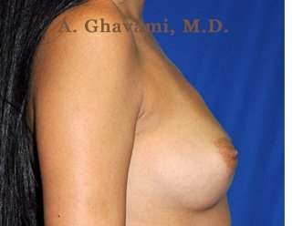 Procedure before and after - before