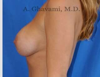 Procedure before and after - after