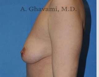 Procedure before and after - before