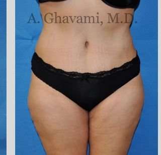 Tummy Tuck before and after - after