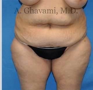 Tummy Tuck before and after - before