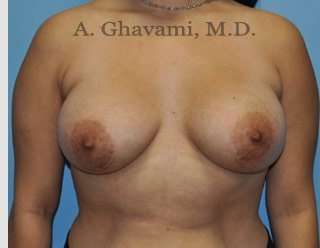 Procedure before and after - after