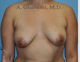 Procedure before and after - before