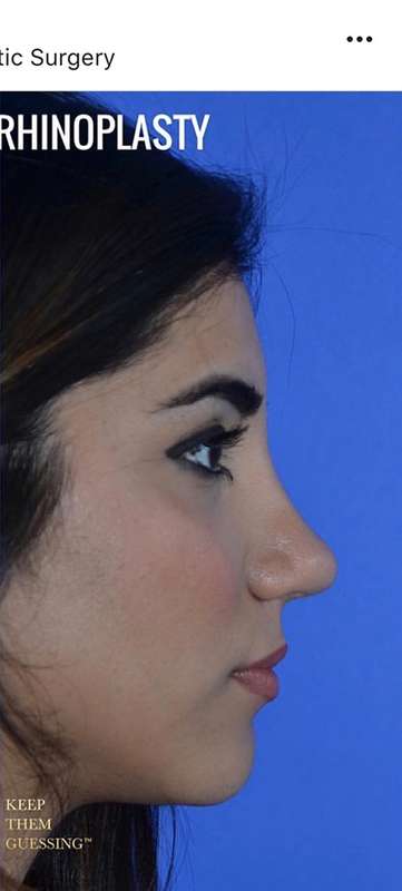 Rhinoplasty before and after - after