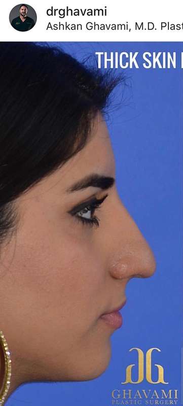 Rhinoplasty before and after - before