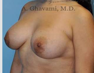 Procedure before and after - after