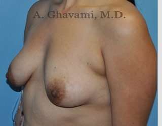 Procedure before and after - before