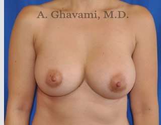Procedure before and after - after