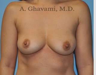 Procedure before and after - before
