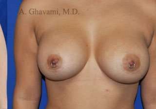 Procedure before and after - after