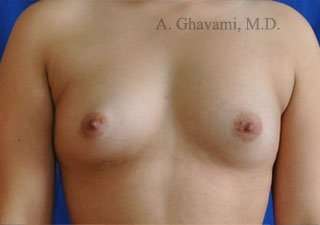 Procedure before and after - before