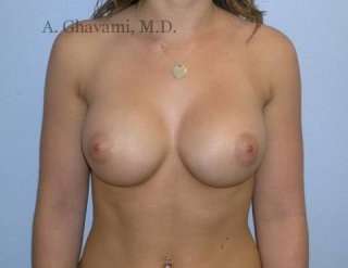 Procedure before and after - after