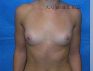 Procedure before and after - before