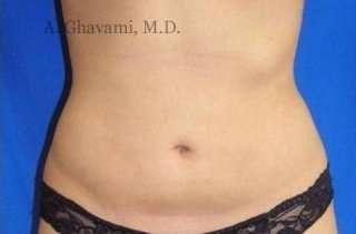Liposuction before and after - after
