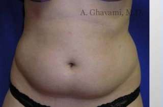 Liposuction before and after - before