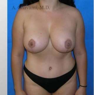 Mommy Makeover before and after - after