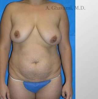 Mommy Makeover before and after - before