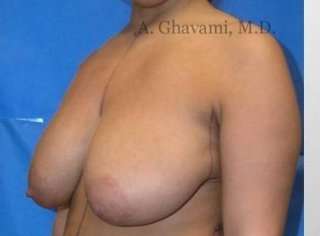 Procedure before and after - before