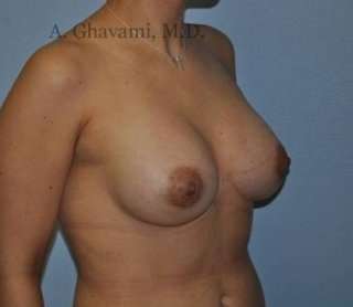 Procedure before and after - after
