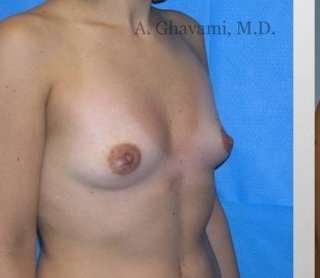 Procedure before and after - before