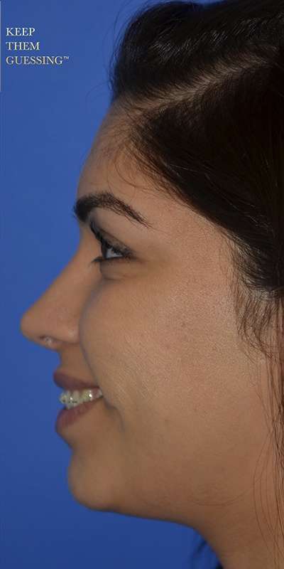 Rhinoplasty before and after - after