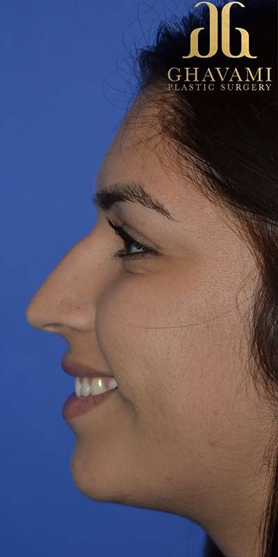 Rhinoplasty before and after - before