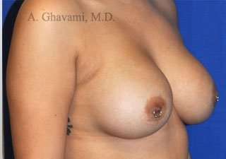 Procedure before and after - after