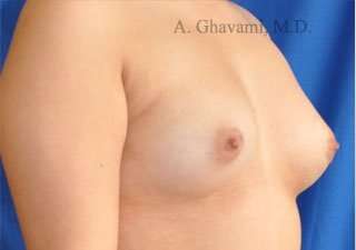 Procedure before and after - before