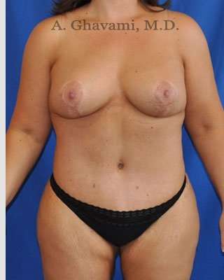 Mommy Makeover before and after - after