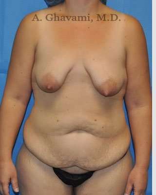 Mommy Makeover before and after - before