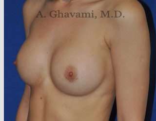 Procedure before and after - after