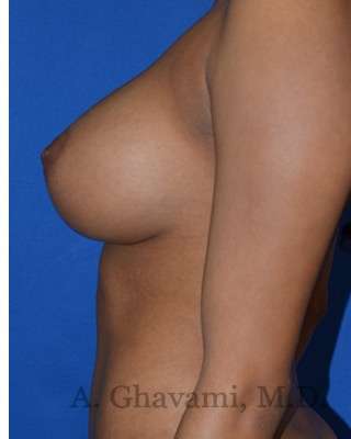 Procedure before and after - after