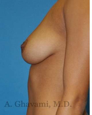 Procedure before and after - before