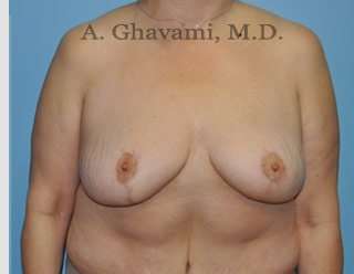 Procedure before and after - after