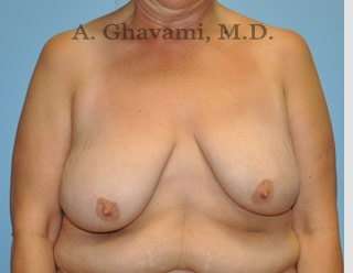 Procedure before and after - before