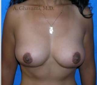 Procedure before and after - after