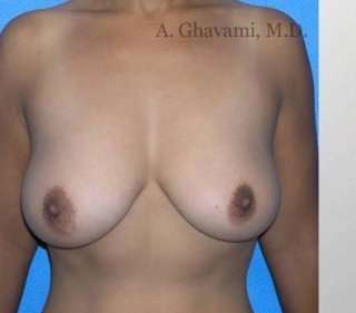 Procedure before and after - before