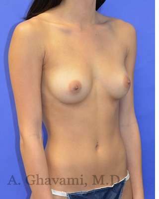 Procedure before and after - before