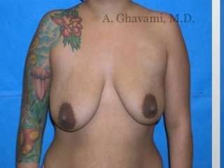Procedure before and after - before