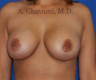 Procedure before and after - after