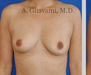 Procedure before and after - before