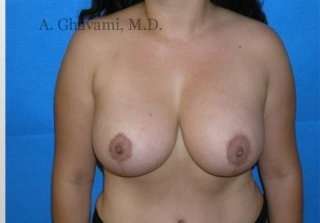 Procedure before and after - after