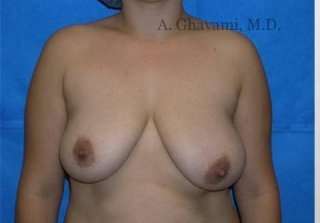 Procedure before and after - before