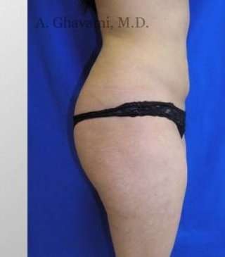 Liposuction before and after - after